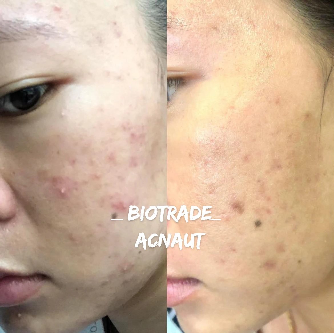 Hình ảnh Thực Tế Review Combo Giảm Mụn Viêm Mủ Biotrade Acnaut - 1Mall.vn